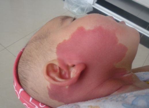 血管瘤鲜红斑痣是什么原因造成的,鲜红斑痣是不是比血管瘤厉害难治