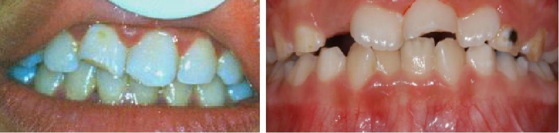 3岁小孩牙齿要怎么保护,儿童牙齿外伤需要检查什么