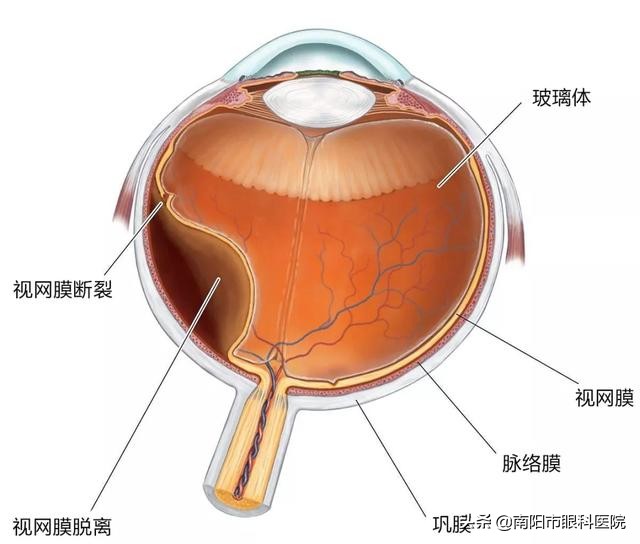 视网膜脱落累及黄斑能彻底治好吗,眼底病变导致视网膜脱落能治好吗
