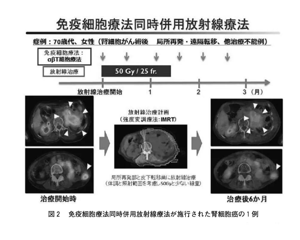 放疗仅是局部治疗?与免疫细胞疗法结合的它将成为抗癌最新利器！