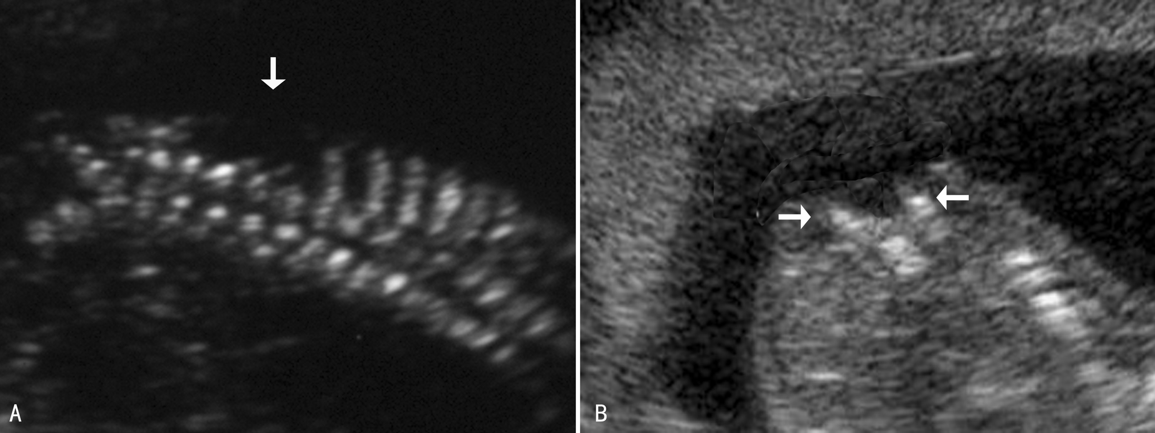 明明白白做超声25-5：胎儿神经管缺陷—脊柱裂