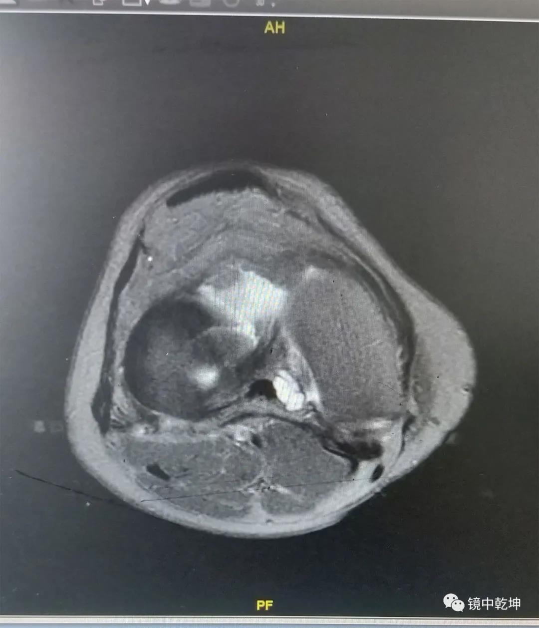 南大二附院系列科普：关节镜手术治疗膝关节半月板损伤