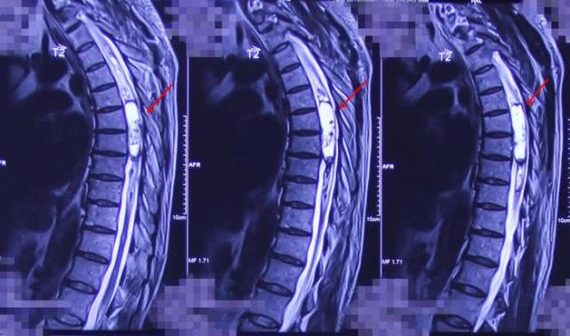 椎管内肿瘤跟椎管肿瘤一样吗,椎管内肿瘤是癌吗