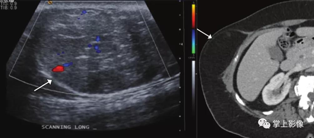 腹壁病变诊断思路,腹部影像诊断读片入门视频