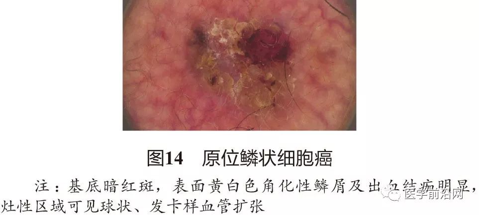 面部常见皮肤病皮肤镜诊断专家共识全文发布
