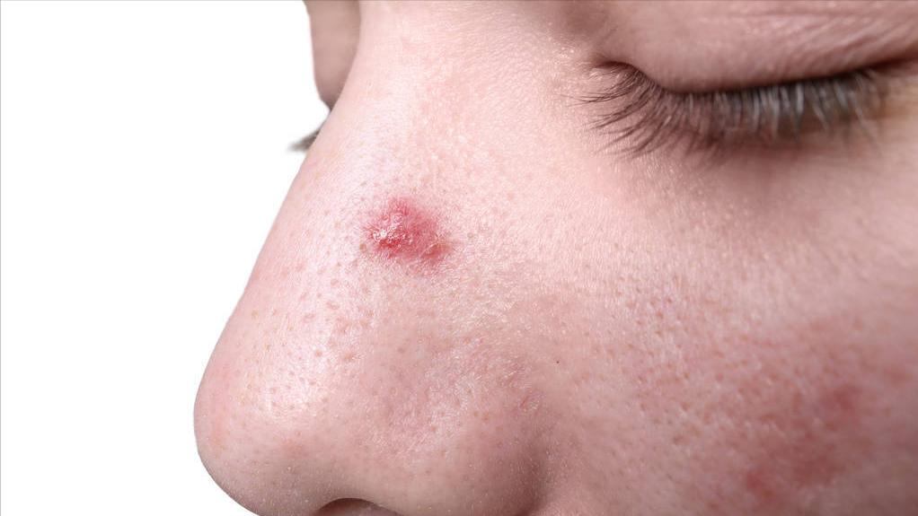 脸上长脓包痘痘快速去掉,脸上长痘痘该怎么调理除湿