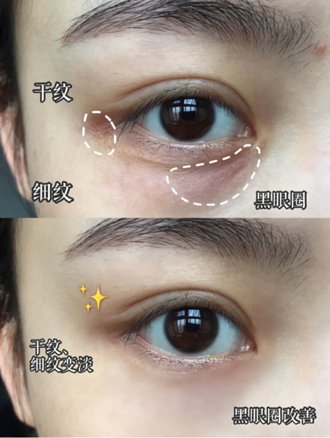 切眼袋会加速衰老的案例,割双眼皮衰老更快