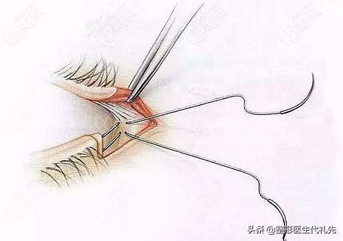 做了外切眼袋怎么消肿最快,内切去眼袋下眼睑外翻
