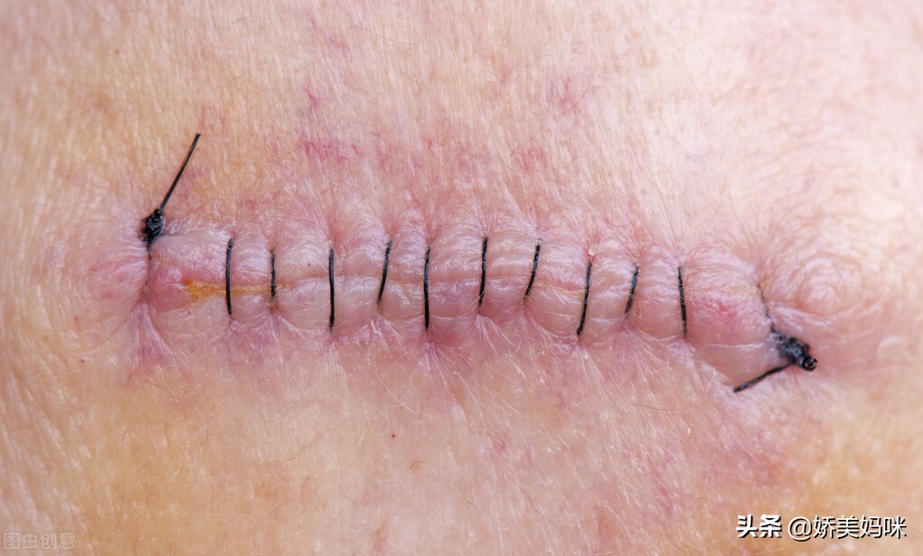 不要小看任何一个创伤,不要忽视产后恢复