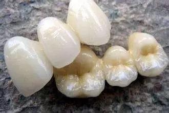 雅悦齿科烤瓷牙视频,雅悦齿科治疗费用