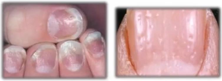 治灰指甲要验血吗,医院检查灰指甲挂号什么科