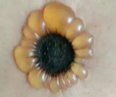 中医传统化脓灸,古人为什么用艾叶艾灸