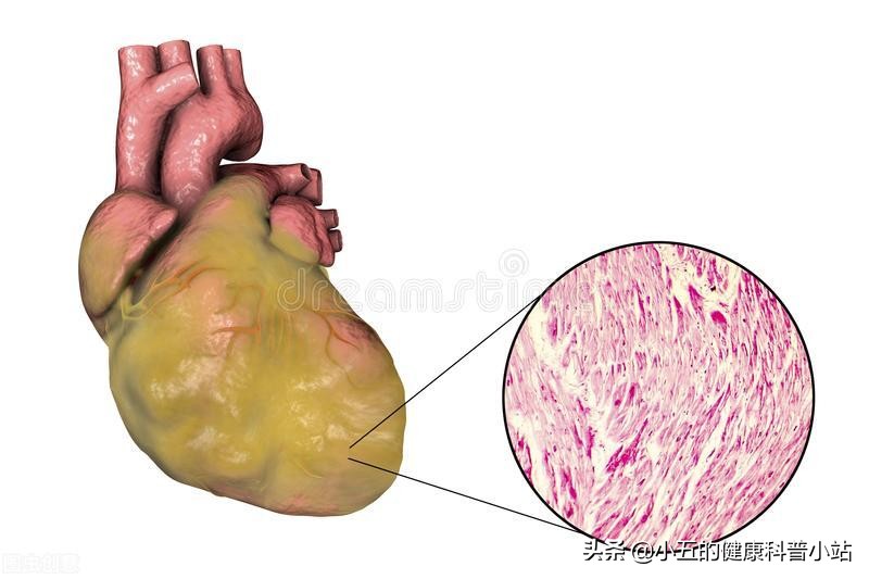 能稳定斑块的中成药,既能降压又能降脂的药