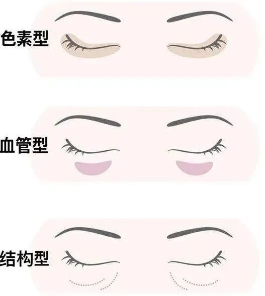 专家说痔疮膏治黑眼圈,网络流行的痔疮膏去黑眼圈