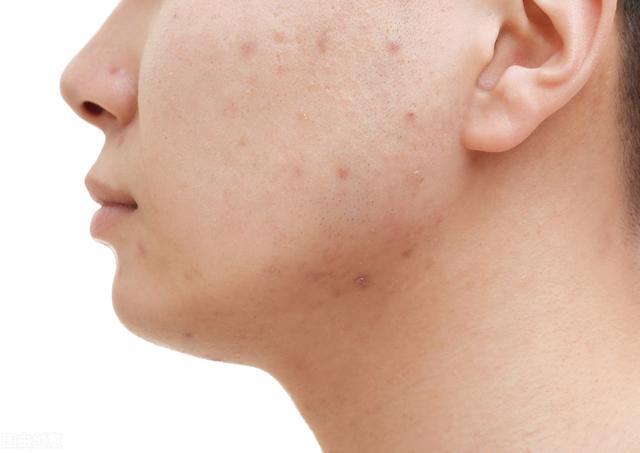 我的祛痘历程完整版,我的祛痘历程30天