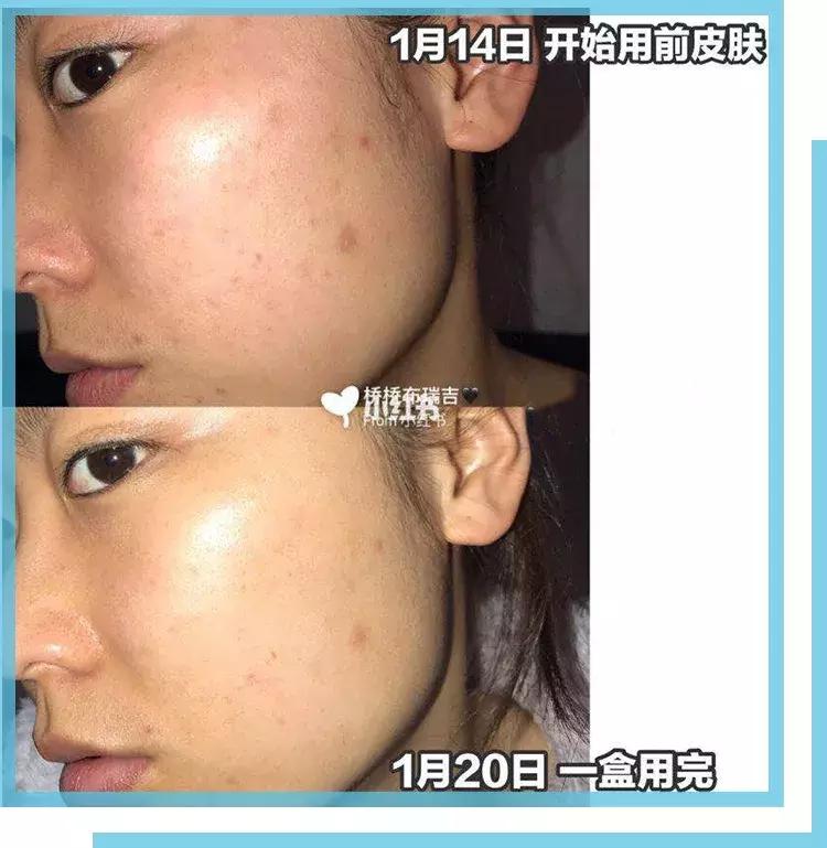 如何有效的祛痘印医美面膜,消炎祛痘的医美面膜