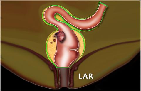 直肠癌“保肛”,你必须知道的知识
