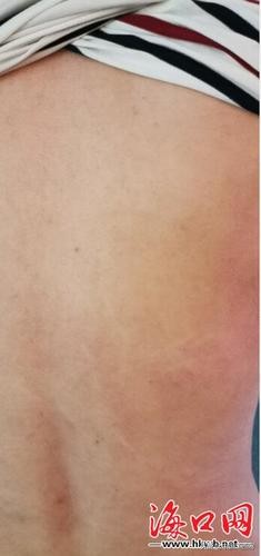 酒店回应客人被蜈蚣咬伤,客人在酒店被马蜂蜇了