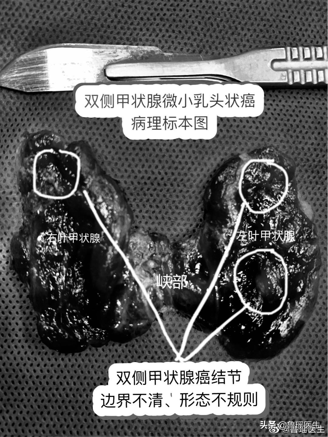 甲状腺结节超声提示恶性五大征象,甲状腺结节b超误诊