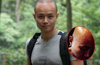 头部血管突出青筋暴起是什么原因,头部青筋