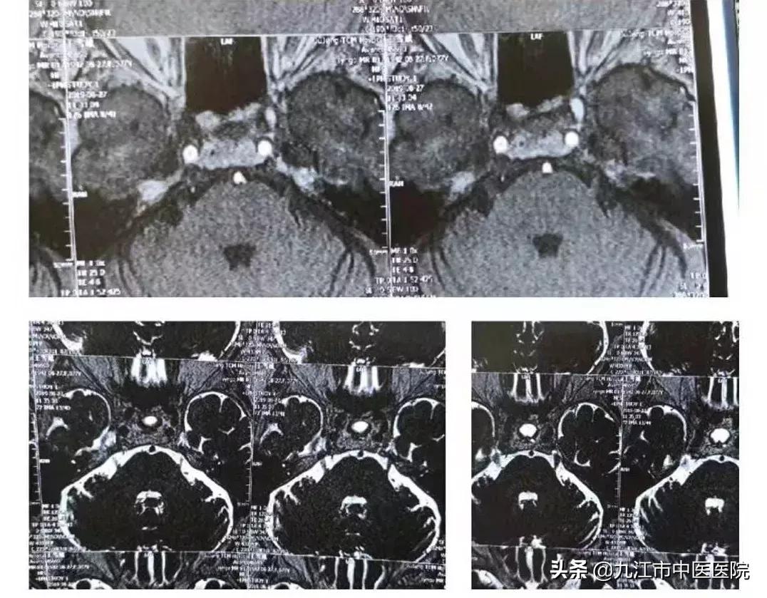 十年治愈面肌痉挛和三叉神经痛患者千例！九江市中医医院专注颅神经疾病治疗