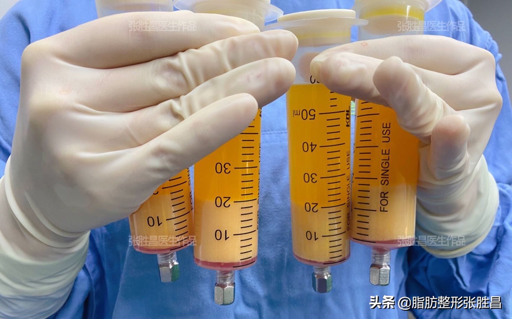 吸脂手术的疤痕怎么消除,吸脂针眼可以激光去除吗