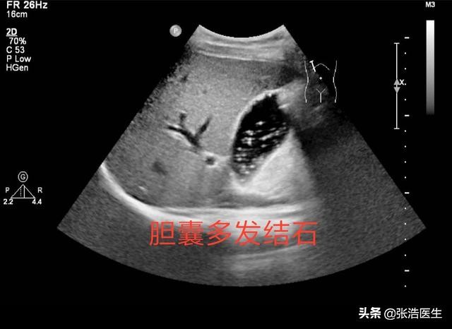 胆不好会出现消化不良吗？日常生活如何改善？