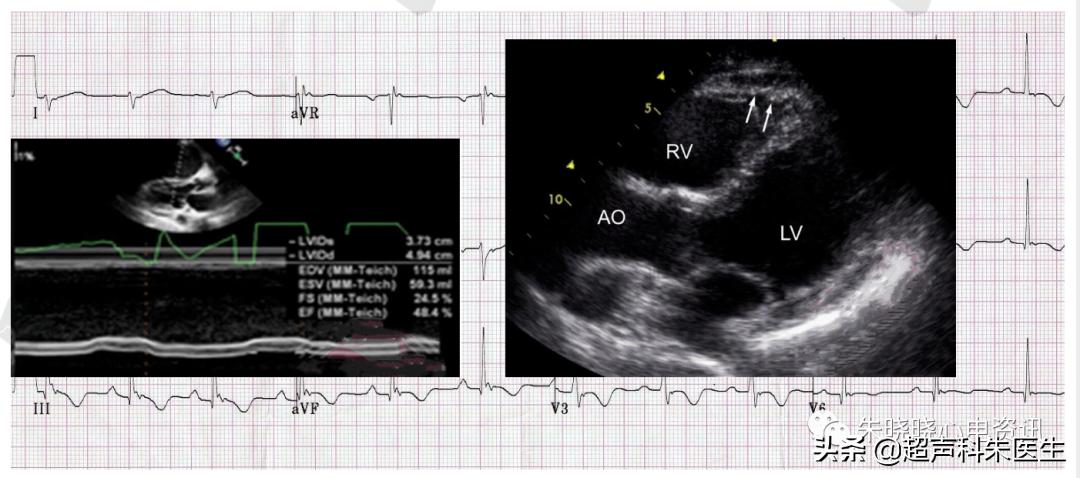 t波倒置诊断,t波倒置如何区分严重程度