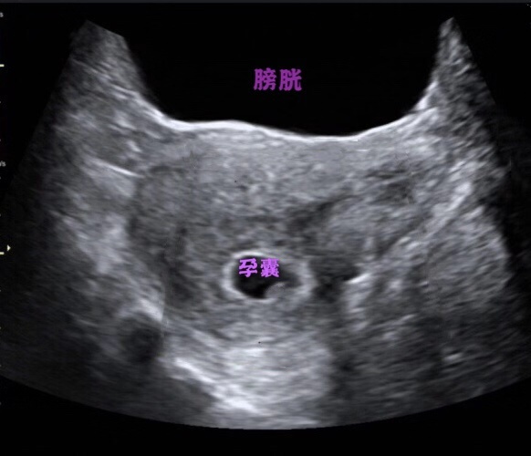 超声检查膀胱没事还要做膀胱镜吗,做彩超憋尿对膀胱有危害吗