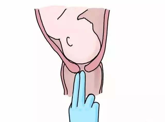 顺产宫口开几指才可以生,宫口开了2指肚子不痛多久生