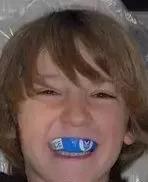 宝宝牙齿磕掉,儿童牙齿磕松了能自己好吗