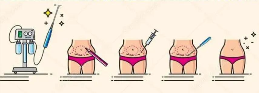 抽脂感染去世的网红,网红抽脂感染离世抖音