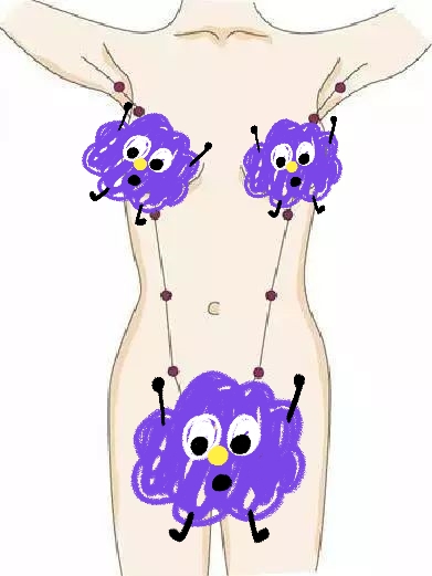 副乳里面有硬块要切除吗,副乳在腋窝下存在什么风险