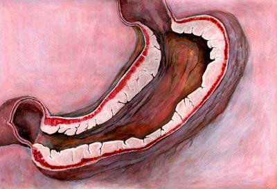 活检是不是确诊肺癌的重要依据,活检诊断是癌症可信吗