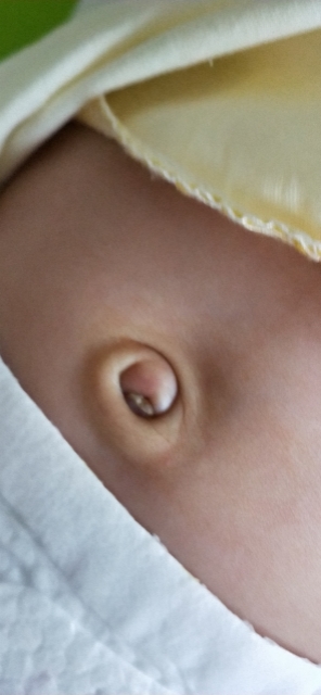 儿童脐茸怎么治,宝宝脐茸怎样处理