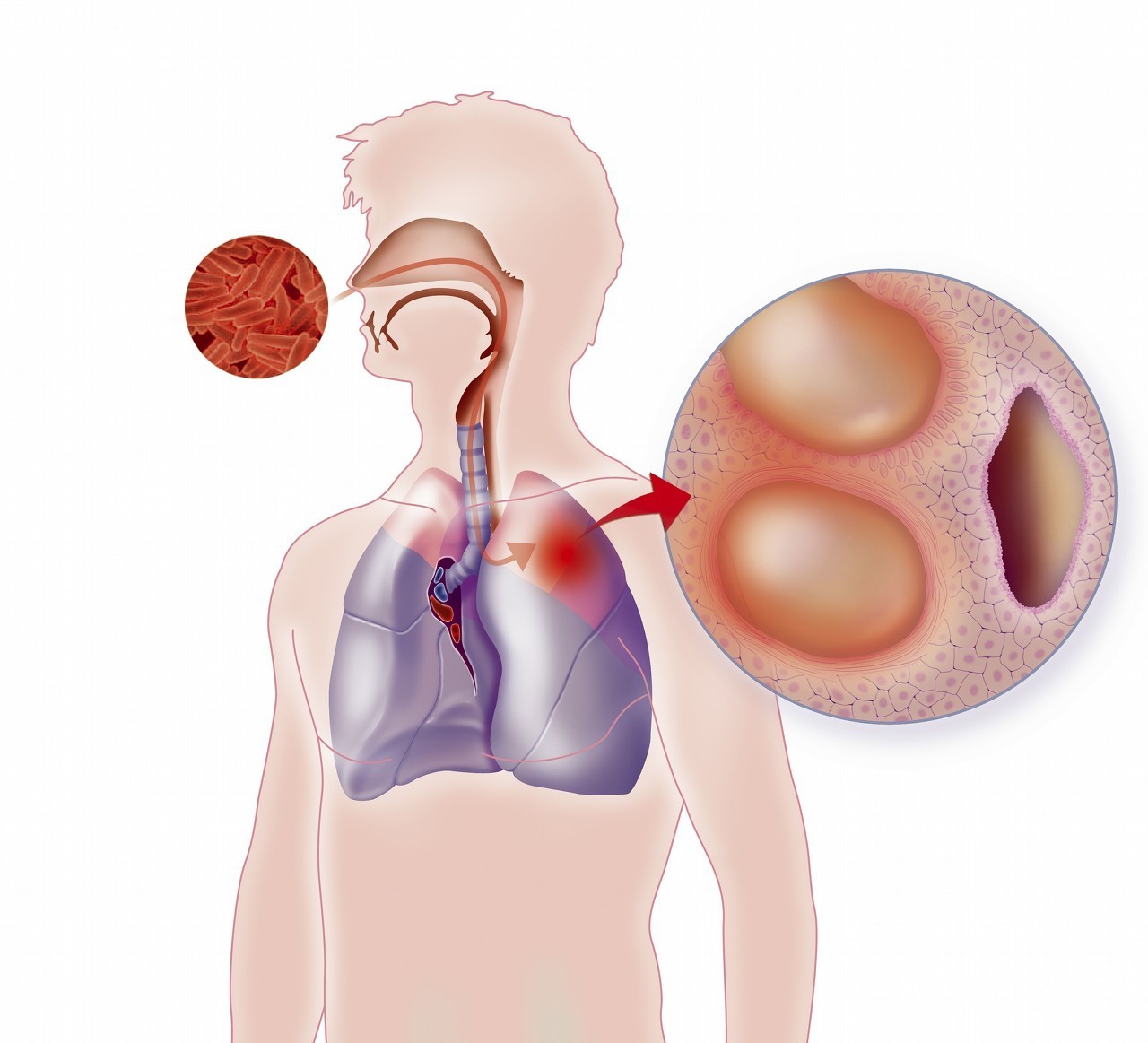 肺结核治疗期间反复低烧正常吗,肺结核治疗期间发低烧正常吗