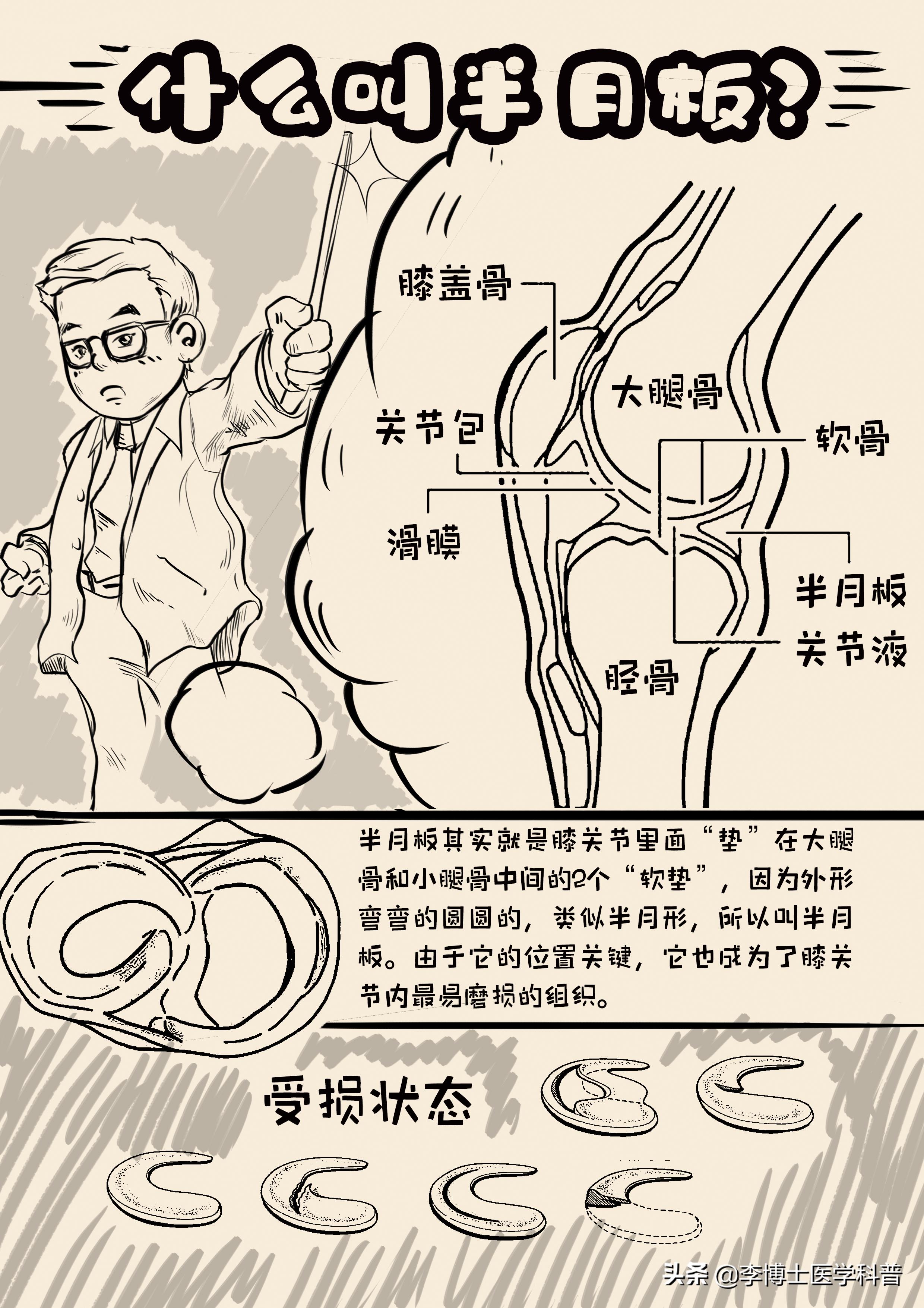半月板平时注意事项怎样恢复更快,半月板深度科普