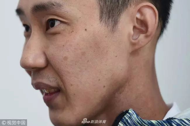 李宗伟质子治疗鼻咽癌,李宗伟鼻咽癌质子哪里做的