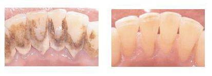 洗牙的过程是怎样的?洗牙有哪些注意事项呢?