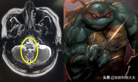 脑出血几年以后复发,脑出血几年后偏瘫越来越严重