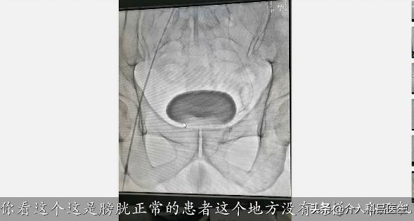 医生给你用图片讲解:前列腺增生如何微创治疗,一看就懂!