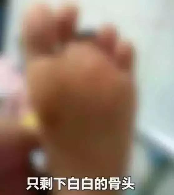 孩子在滑滑梯头朝下滑导致骨折,小孩玩滑梯骨折了怎么办