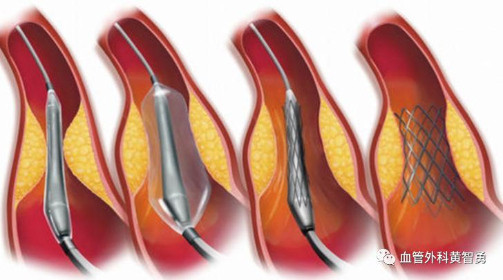 脑血栓取栓最新指南,脑卒中手术介入取栓后多久恢复