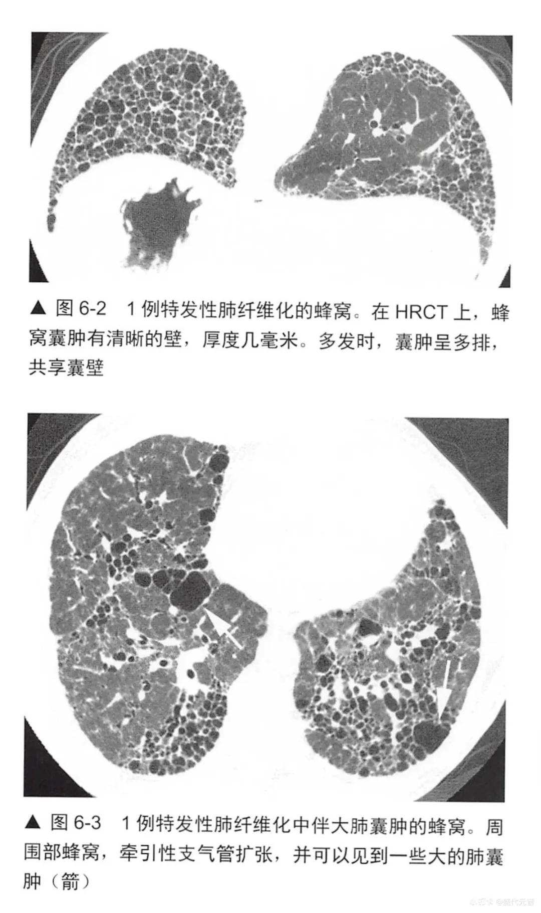肺囊肿ct图像,肺hrct是低剂量的吗