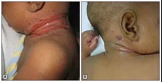 宝宝淹脖子破皮处结痂怎么处理,宝宝淹脖子发红出血怎么办