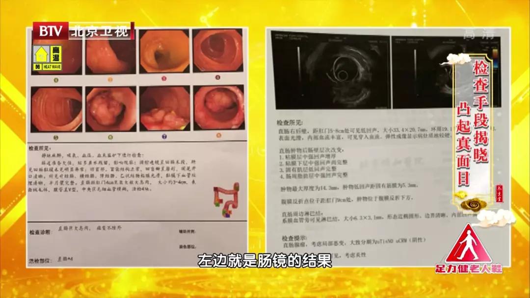 肛周凸起全当痔疮？小心是恶性肿瘤！两步自检法，发现癌变风险