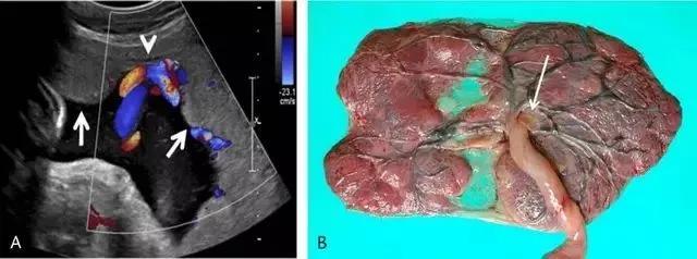 临床上最常见的异常胎盘,前置胎盘和低置胎盘超声