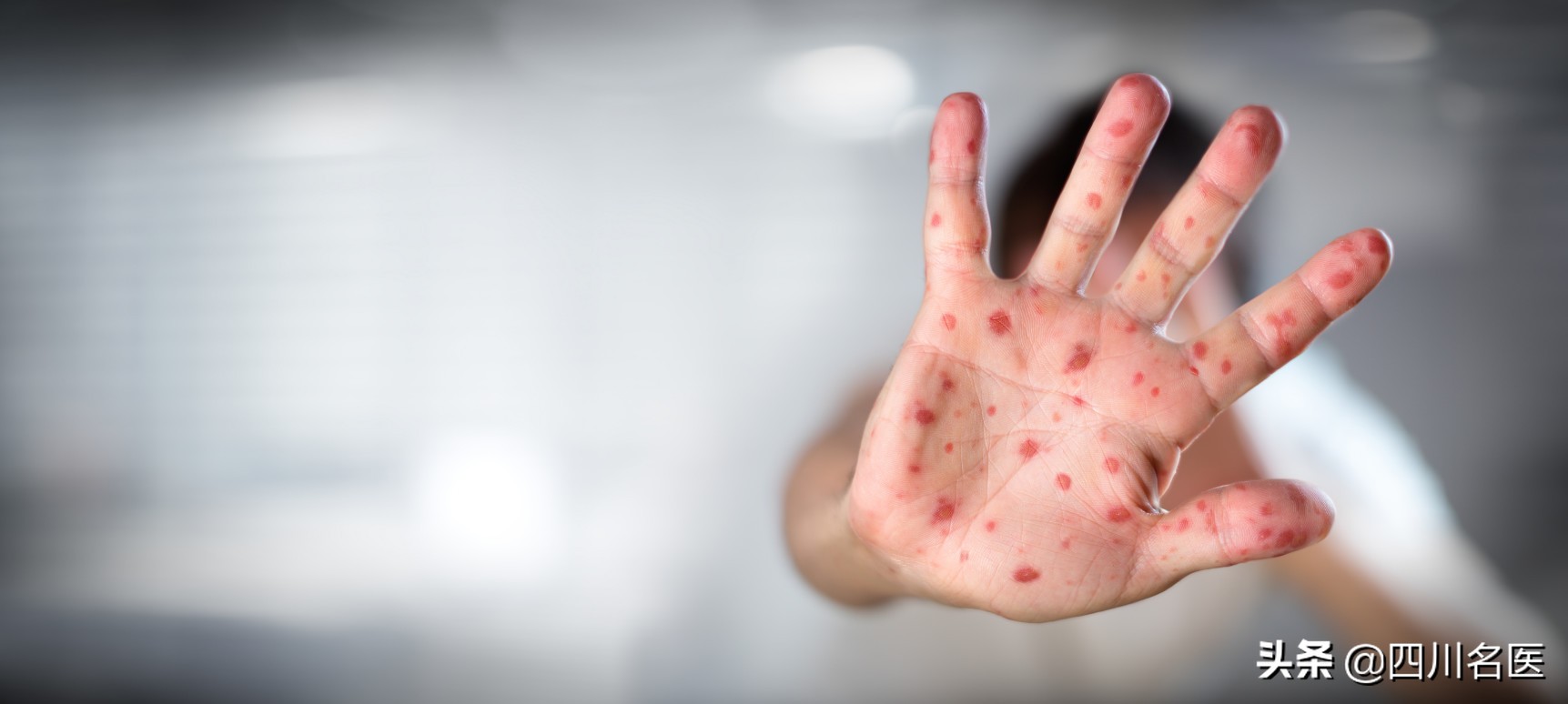 2岁孩子病毒发烧39度反反复复,小孩疱疹一直高烧39以上怎么办