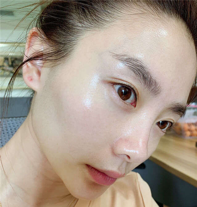 脸上闭口粉刺怎么治疗,脸上闭口粉刺怎么才能彻底处理