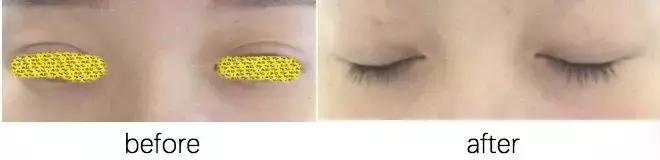 医美祛眼袋分享,医美分享案例